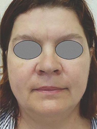 après Fotona 4D visage liege