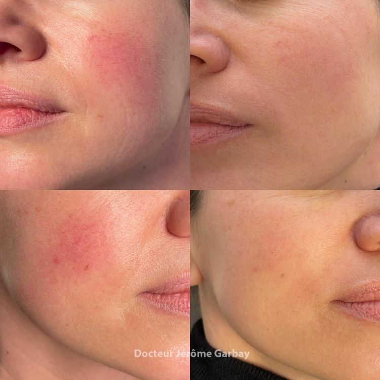 laser vasculaire liege