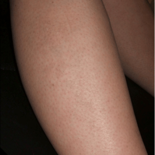 détatouage laser liege