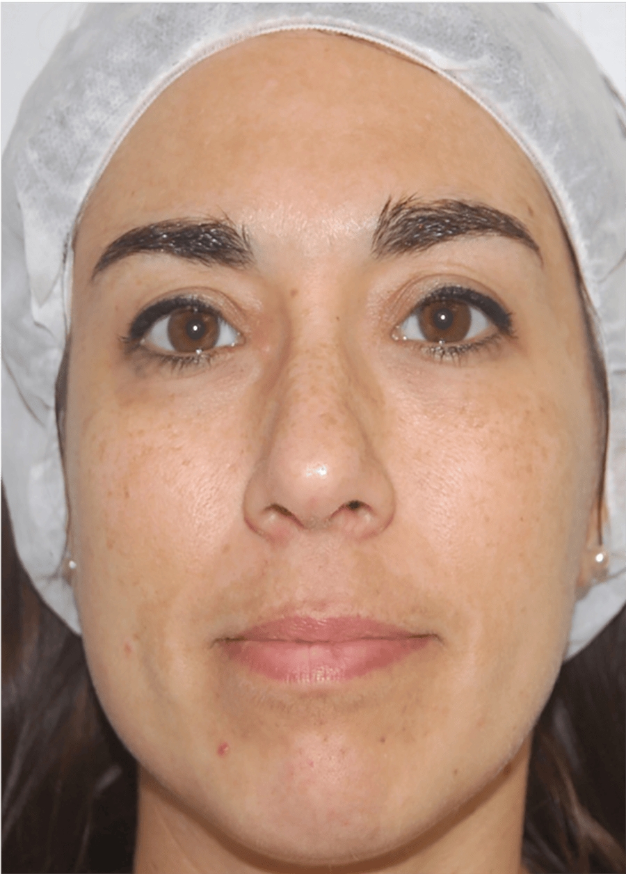 Saizar toning after tx