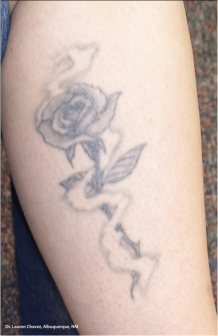 Faut-il s’inquiéter du tatouage ? 