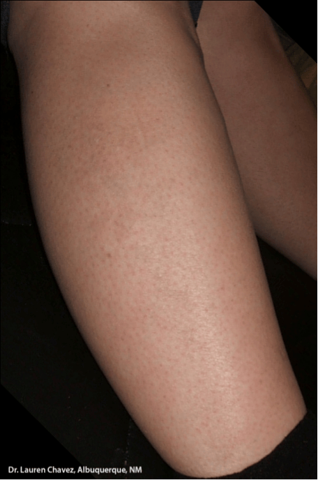 detatouage laser liege 3