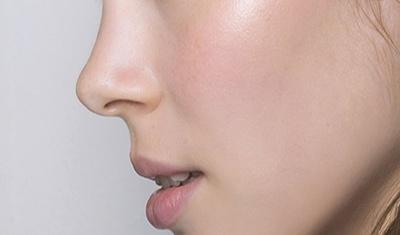 rhinoplastie liege