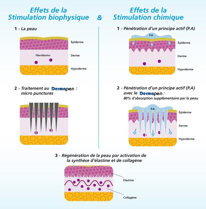 microneedling liege