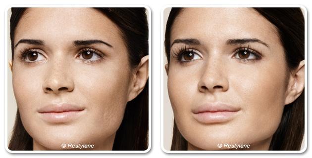 skinbooster dr garbay