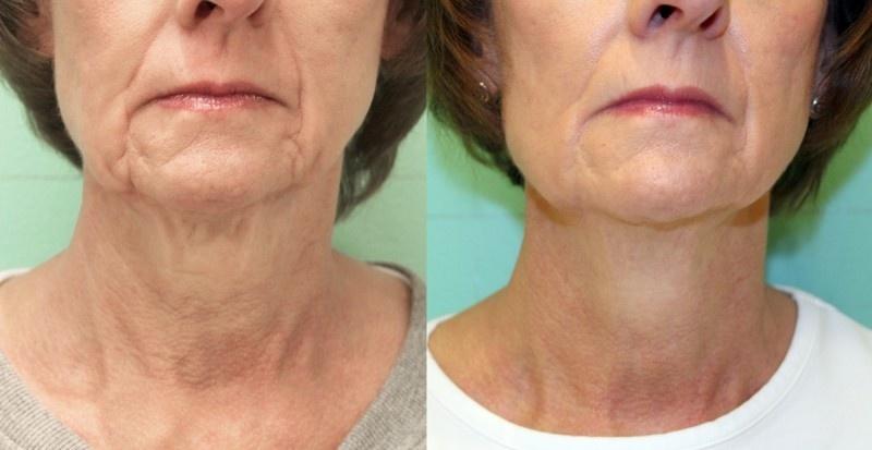 Exilis elite, un traitement de choix dés la rentrée 