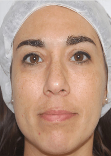 Après lasemd babyface melasma liege