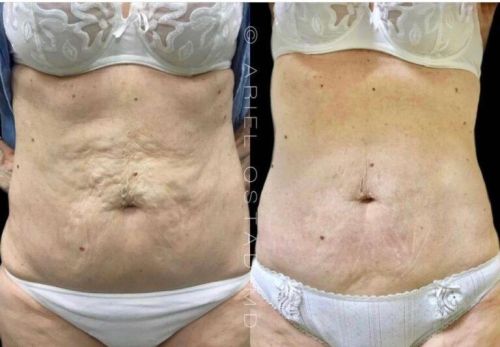 cellulite ventre liege