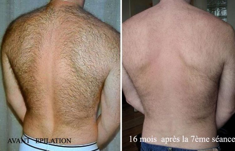 epilation laser dos liege verviers