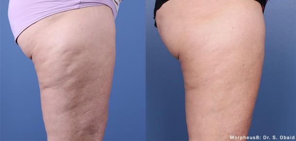 cellulite liege verviers