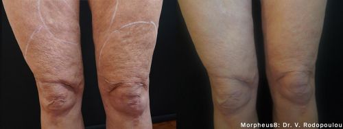 cellulite liege morpheus