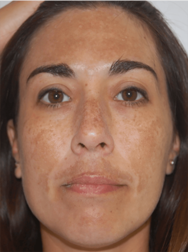 Avant lasemd babyface melasma liege