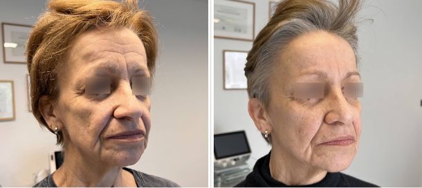 botox liege