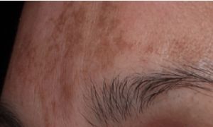 melasma liege