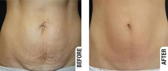 relachement cutane liege
