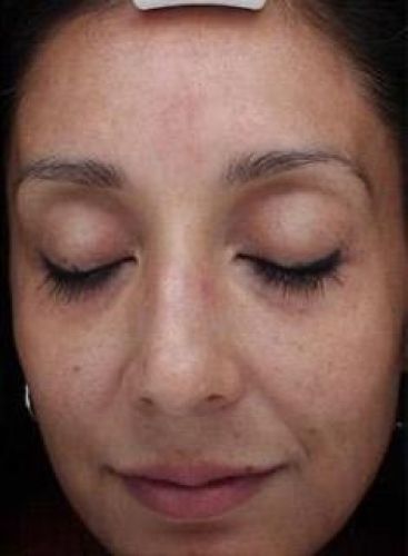 melasma liege