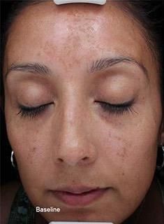 melasma liege