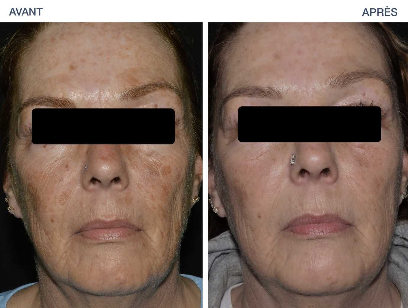 taches laser liege