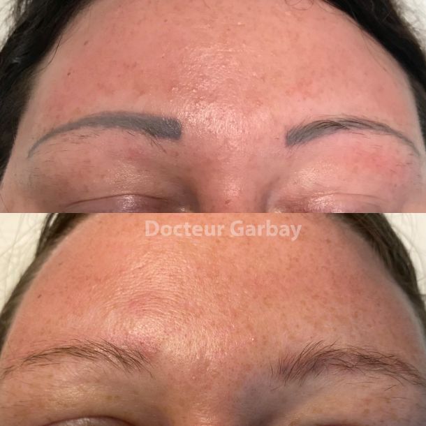 détatouage laser liege sourcils